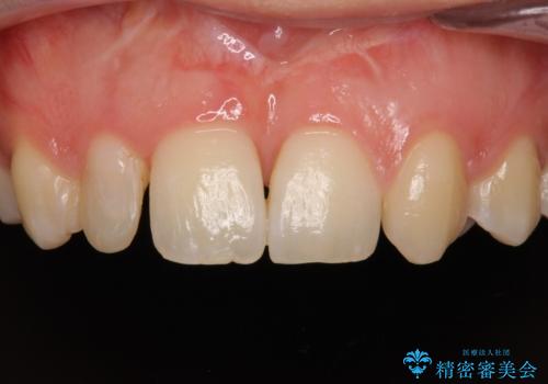 矮小歯と欠損によるずれた位置の大きな歯　オールセラミッククラウンで自然にの症例 治療前