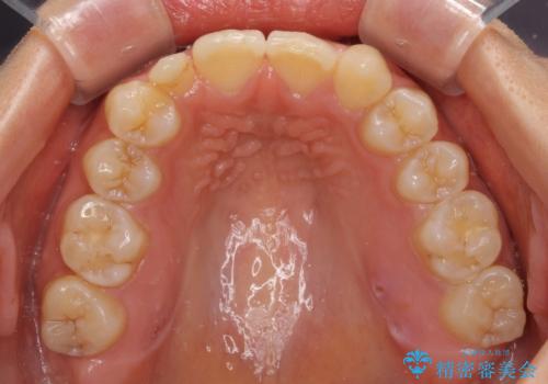 矮小歯と欠損によるずれた位置の大きな歯　オールセラミッククラウンで自然にの治療前