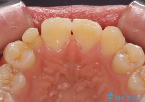 矮小歯と欠損によるずれた位置の大きな歯 オールセラミッククラウンで自然にの治療前