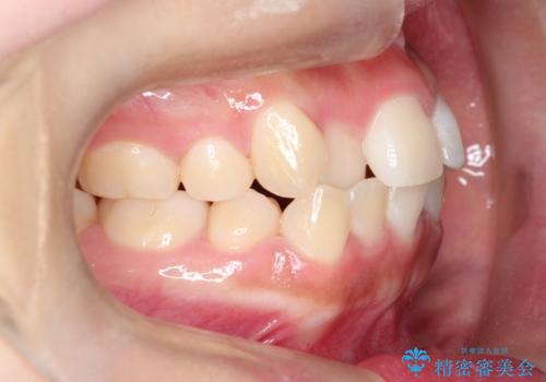 美しい口元へ、短期間で綺麗な歯並びに変身の治療前