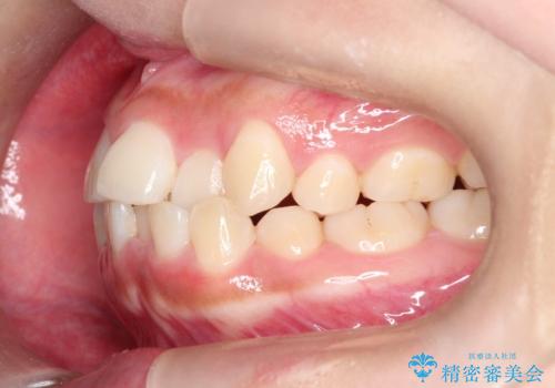 美しい口元へ、短期間で綺麗な歯並びに変身の治療前