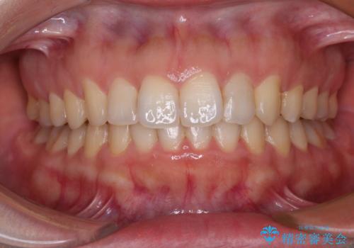 インビザライン矯正で前歯のデコボコを改善の症例 治療後