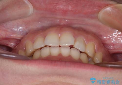 インビザライン矯正で前歯のデコボコを改善の治療後