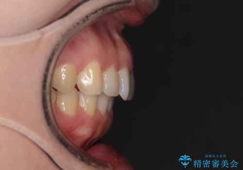 インビザライン矯正で前歯のデコボコを改善の治療後