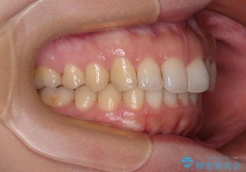 インビザライン矯正で前歯のデコボコを改善の治療後