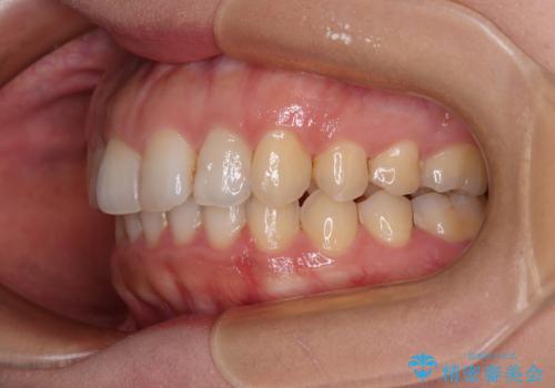 インビザライン矯正で前歯のデコボコを改善の治療後