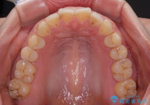 インビザライン矯正で前歯のデコボコを改善の治療後