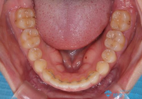 インビザライン矯正で前歯のデコボコを改善の治療後