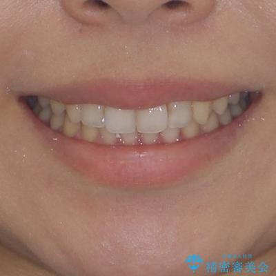 インビザライン矯正で前歯のデコボコを改善の治療後（顔貌）