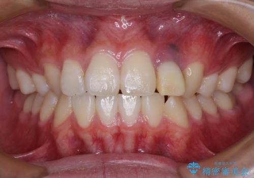 抜歯と言われた前歯 牽引してセラミッククラウンで保存するの治療前