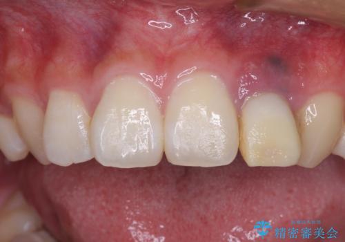 抜歯と言われた前歯　牽引してセラミッククラウンで保存するの症例 治療前