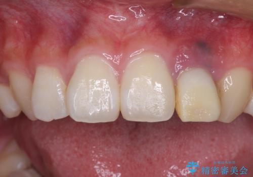 抜歯と言われた前歯 牽引してセラミッククラウンで保存するの症例 治療前