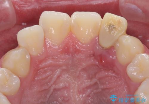 抜歯と言われた前歯 牽引してセラミッククラウンで保存するの治療前