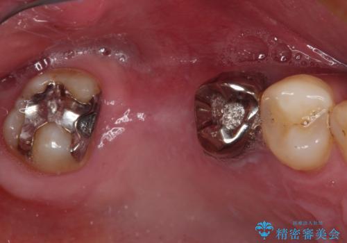 奥歯の欠損部　インプラント補綴治療の症例 治療前