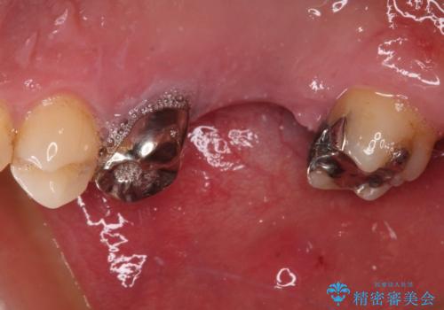 奥歯の欠損部　インプラント補綴治療の治療前