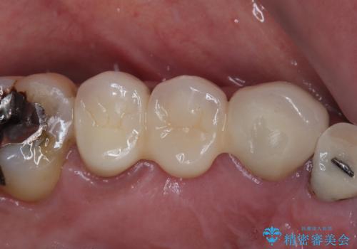 破折した歯 オールセラミックブリッジの補綴治療の治療後