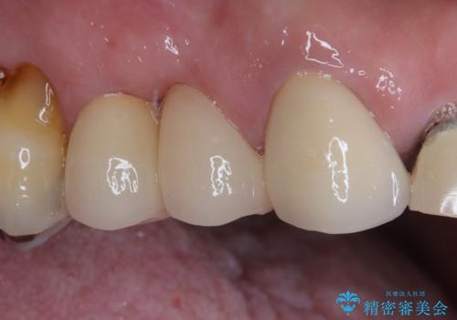 破折した歯 オールセラミックブリッジの補綴治療の症例 治療後