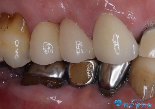 破折した歯 オールセラミックブリッジの補綴治療の治療後