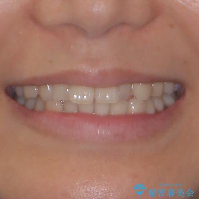 上下前歯のデコボコ ワイヤー装置で楽して改善の治療前(顔貌)