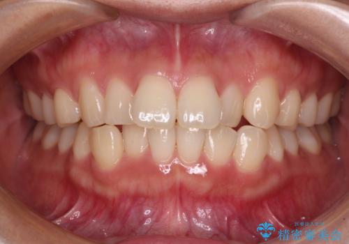 上下前歯のデコボコ ワイヤー装置で楽して改善の治療前