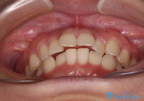 上下前歯のデコボコ ワイヤー装置で楽して改善の治療前