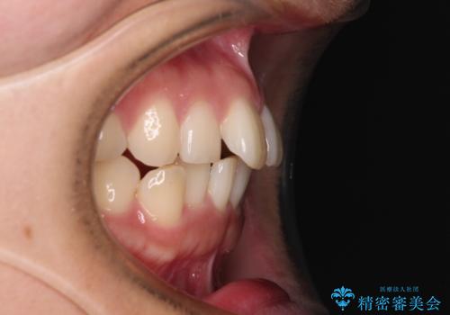 上下前歯のデコボコ ワイヤー装置で楽して改善の治療前