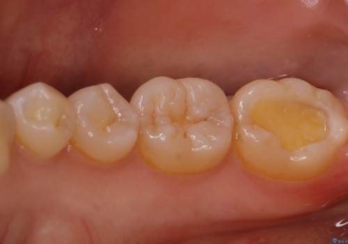 昔治した歯の形が気になる　セラミックインレーでキレイな歯に!の治療中