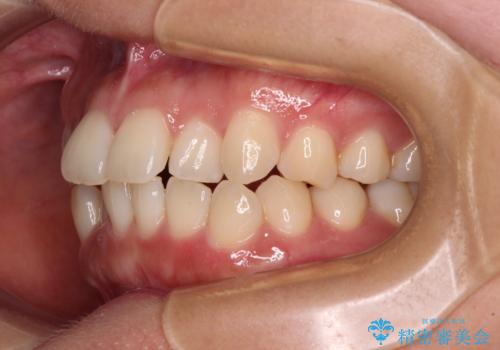 上下前歯のデコボコ ワイヤー装置で楽して改善の治療前