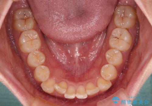 上下前歯のデコボコ ワイヤー装置で楽して改善の治療前