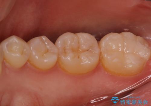 昔治した歯の形が気になる　セラミックインレーでキレイな歯に!の症例 治療後