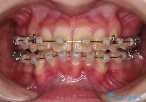 【モニター】出っ歯と八重歯 抜歯矯正でスッキリとした口元にの治療中