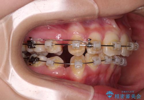 【モニター】出っ歯と八重歯　抜歯矯正でスッキリとした口元にの治療中