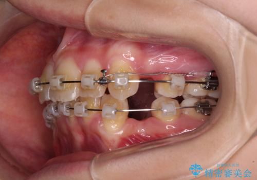 【モニター】出っ歯と八重歯 抜歯矯正でスッキリとした口元にの治療中