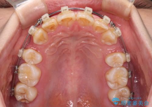 【モニター】出っ歯と八重歯 抜歯矯正でスッキリとした口元にの治療中