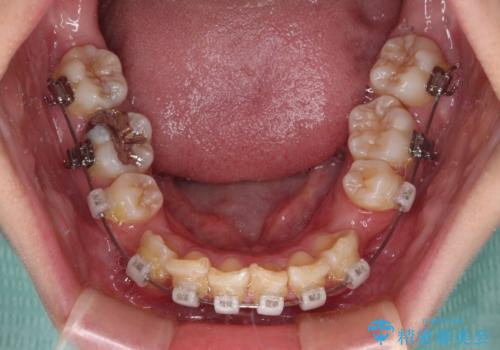 【モニター】出っ歯と八重歯 抜歯矯正でスッキリとした口元にの治療中