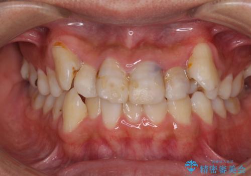 デコボコと変色した前歯　抜歯矯正と審美歯科治療の症例 治療前