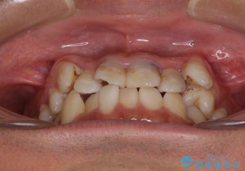 デコボコと変色した前歯 抜歯矯正と審美歯科治療の治療前