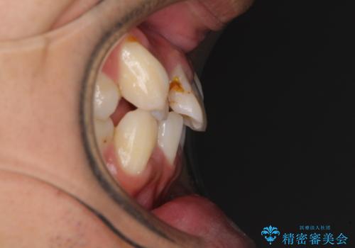 デコボコと変色した前歯 抜歯矯正と審美歯科治療の治療前