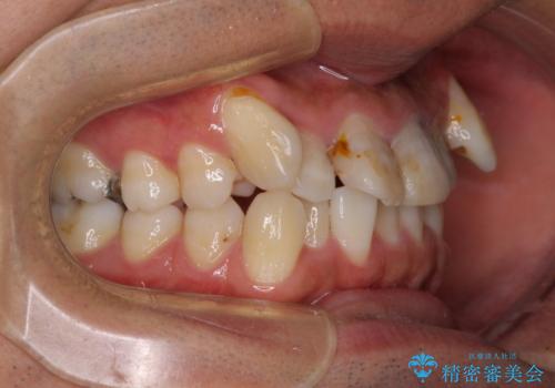 デコボコと変色した前歯　抜歯矯正と審美歯科治療の治療前