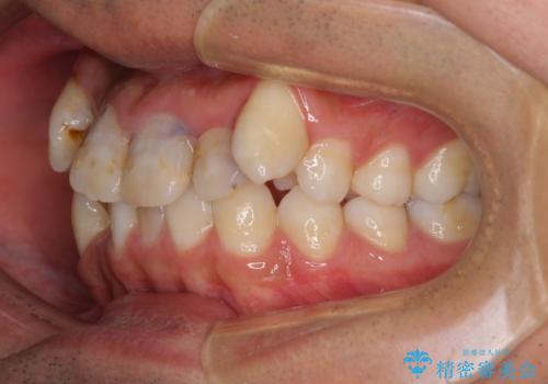 デコボコと変色した前歯 抜歯矯正と審美歯科治療の治療前