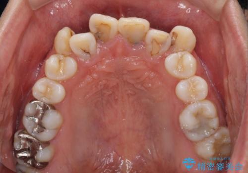 デコボコと変色した前歯 抜歯矯正と審美歯科治療の治療前