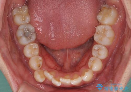 デコボコと変色した前歯 抜歯矯正と審美歯科治療の治療前