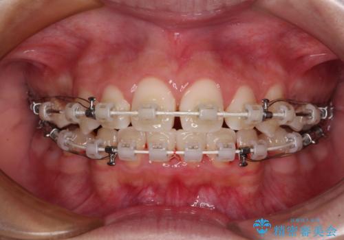気がつくと唇があいてしまう ワイヤー装置での抜歯矯正の治療中