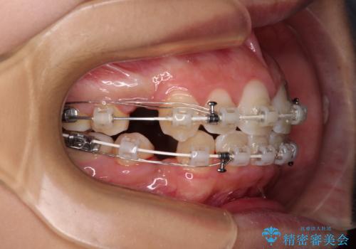 気がつくと唇があいてしまう ワイヤー装置での抜歯矯正の治療中