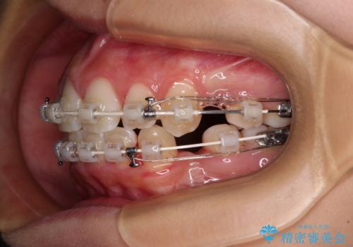 気がつくと唇があいてしまう ワイヤー装置での抜歯矯正の治療中