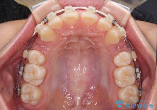 気がつくと唇があいてしまう ワイヤー装置での抜歯矯正の治療中