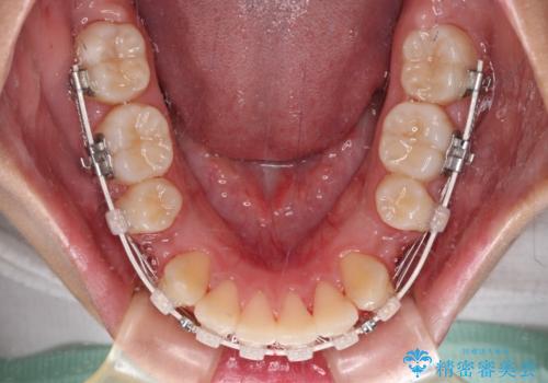 気がつくと唇があいてしまう ワイヤー装置での抜歯矯正の治療中