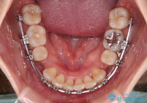 気になる出っ歯を治したい 抜歯矯正でスッキリした横顔にの治療中