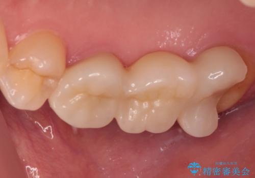 壊れやすいブリッジ インプラント治療で安定した咬み合わせにの治療前