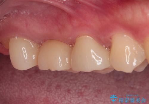壊れやすいブリッジ インプラント治療で安定した咬み合わせにの治療前